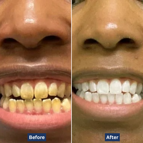 ToothArmor™ Enamel Armor Drops